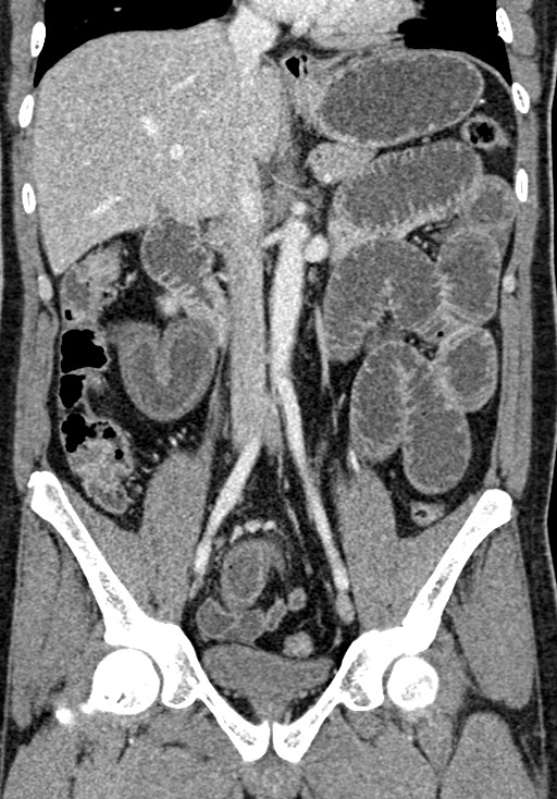 Adhesional small bowel obstruction (Radiopaedia 58900-66131 Coronal C+ portal venous phase 141).jpg