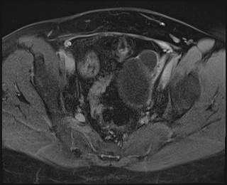 File:Adnexal multilocular cyst (O-RADS US 3. O-RADS MRI 3) (Radiopaedia 87426-103754 Axial 237).jpeg