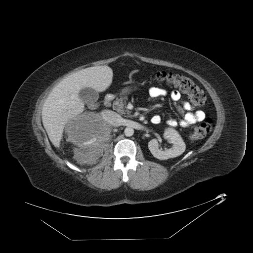 Adrenal angiosarcoma (Radiopaedia 81081-94671 Axial C+ portal venous phase 31).jpg