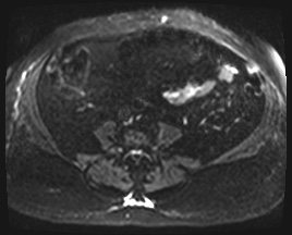 Adrenal cortical carcinoma (Radiopaedia 64017-72770 Axial DWI 42).jpg