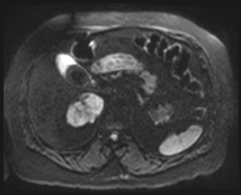 File:Adrenal cortical carcinoma (Radiopaedia 64017-72770 Axial DWI 57).jpg