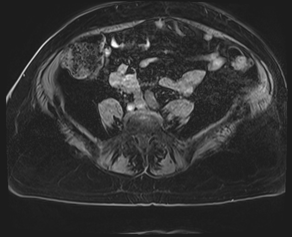 File:Adrenal cortical carcinoma (Radiopaedia 64017-72770 Axial T1 C+ fat sat 60).jpg