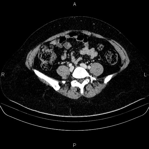 Adrenal cortical carcinoma (Radiopaedia 84882-100379 Axial C+ portal venous phase 63).jpg