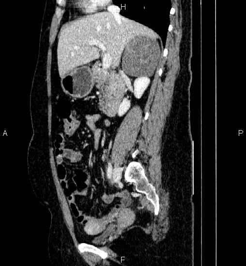 Adrenal cortical carcinoma (Radiopaedia 84882-100379 Sagittal C+ portal venous phase 36).jpg