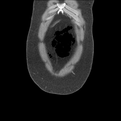 Adrenal cyst (Radiopaedia 45625-49776 Coronal C+ portal venous phase 11).png
