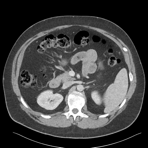 File:Adrenal cyst (Radiopaedia 45625-49777 Axial C+ portal venous phase 40).png