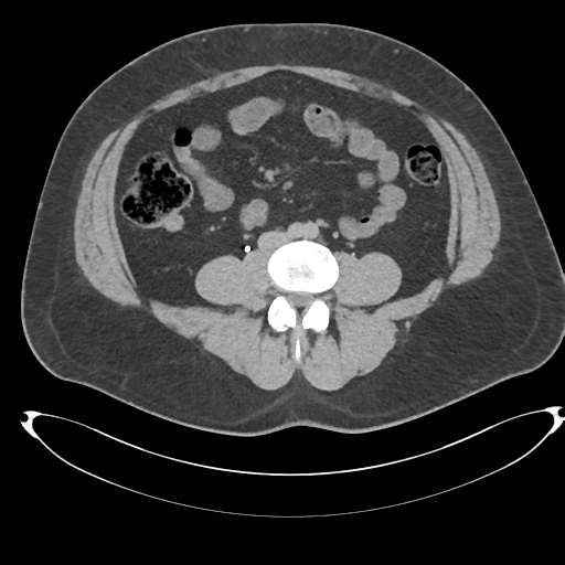 Adrenal cyst (Radiopaedia 45625-49778 AXIAL THICK 15 min 66).png