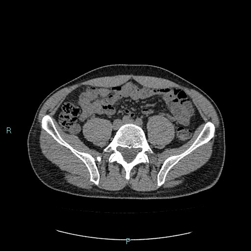 Adrenal cystic lymphangioma (Radiopaedia 83161-97534 Axial non-contrast 65).jpg