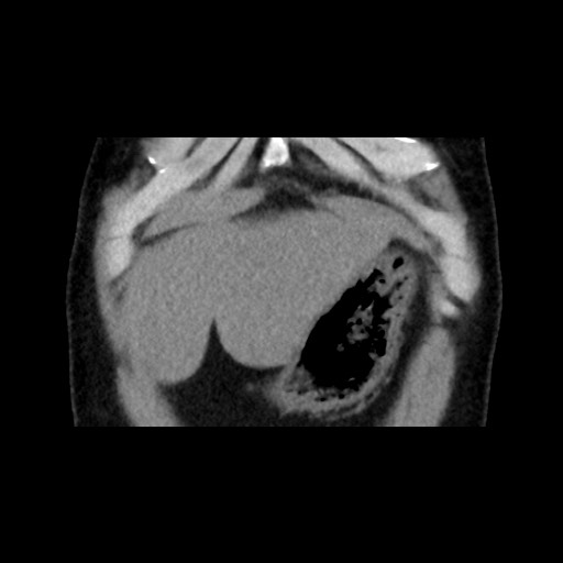 Adrenal gland trauma (Radiopaedia 81351-95079 Coronal non-contrast 16).jpg
