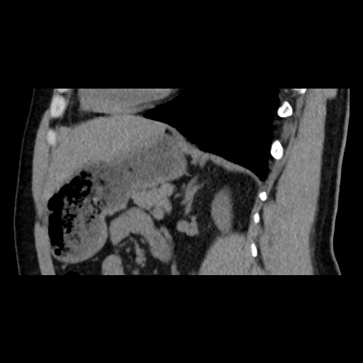 Adrenal gland trauma (Radiopaedia 81351-95079 Sagittal non-contrast 63).jpg