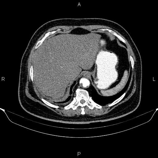 Adrenal hemorrhage (Radiopaedia 62622-70916 Axial C+ arterial phase 51).jpg