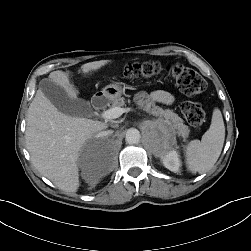 Adrenal lymphoma (Radiopaedia 73730-84529 Axial C+ portal venous phase 31).jpg