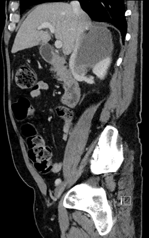Adrenal lymphoma (Radiopaedia 73730-84529 Sagittal C+ portal venous phase 42).jpg