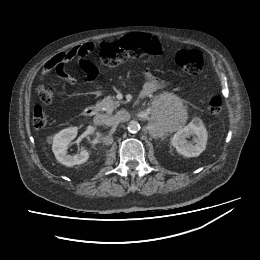 Adrenal lymphoma (Radiopaedia 84145-99415 Axial C+ portal venous phase 52).jpg