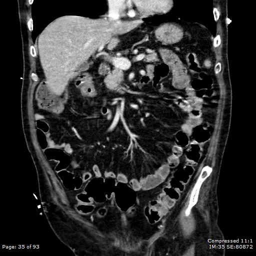 Adrenal metastasis (Radiopaedia 78425-91079 Sagittal C+ portal venous phase 22).jpg