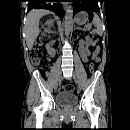 File:Adrenal myelolipoma (Radiopaedia 41843-44834 Coronal non-contrast 7).jpg