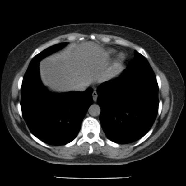 File:Adrenal myelolipoma (Radiopaedia 43401-46759 Axial non-contrast 7).jpg