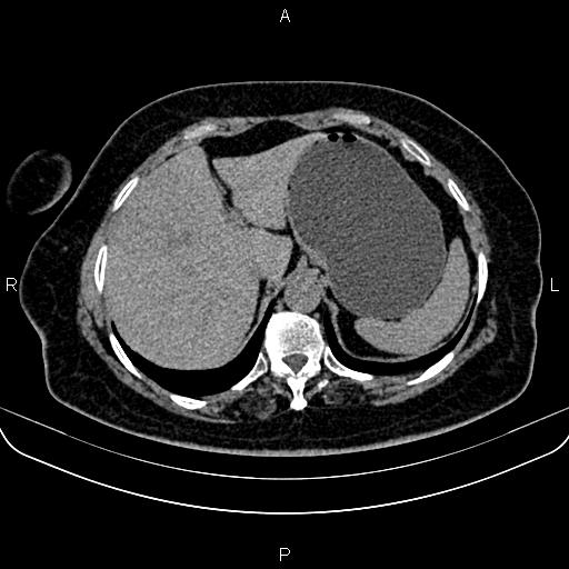 Adrenal myelolipoma (Radiopaedia 82742-96986 Axial non-contrast 27).jpg