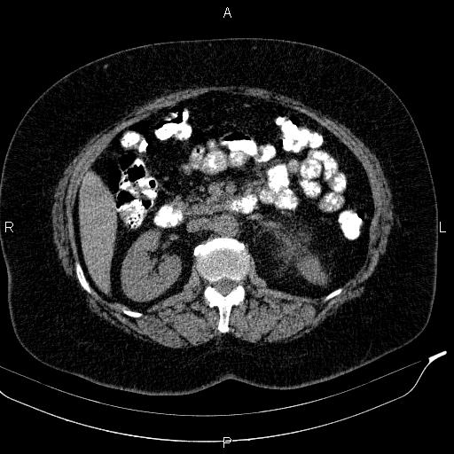 Adrenal myelolipoma (Radiopaedia 84319-99617 Axial With oral contrast 91).jpg