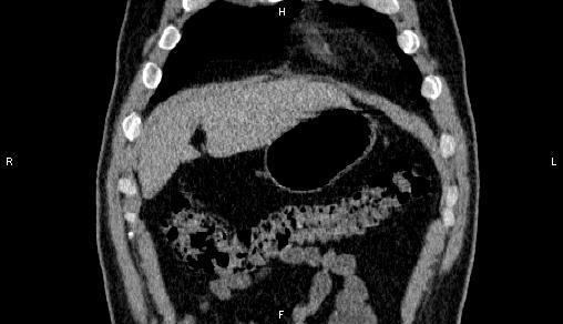 Adrenal myelolipoma (Radiopaedia 84321-99619 Coronal non-contrast 10).jpg