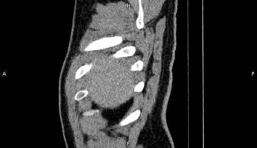 Adrenal myelolipoma (Radiopaedia 84321-99619 Sagittal non-contrast 7).jpg
