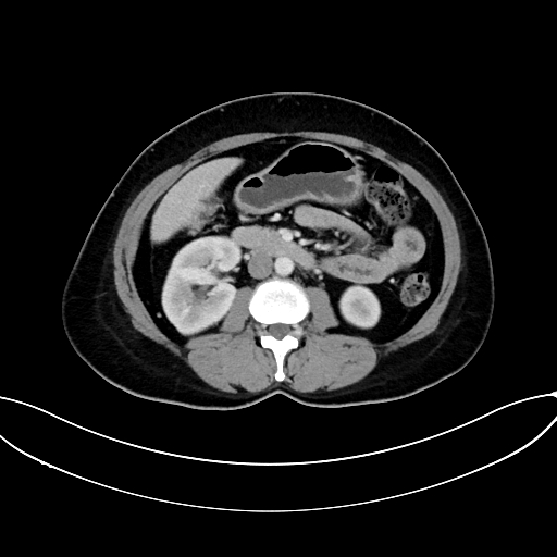 Adrenocortical carcinoma (Radiopaedia 87281-103569 Axial C+ portal venous phase 42).jpg