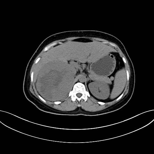 Adrenocortical carcinoma (Radiopaedia 87281-103569 Axial non-contrast 28).jpg