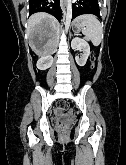 Adrenocortical carcinoma (Radiopaedia 87281-103569 Coronal C+ portal venous phase 80).jpg