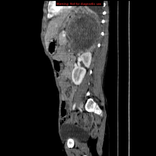 File:Adrenocortical carcinoma (Radiopaedia 9449-10131 Sagittal C+ portal venous phase 11).jpg
