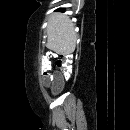 File:Afferent loop syndrome - secondary to incarcerated trocar site hernia (Radiopaedia 82959-97305 Sagittal C+ portal venous phase 133).jpg
