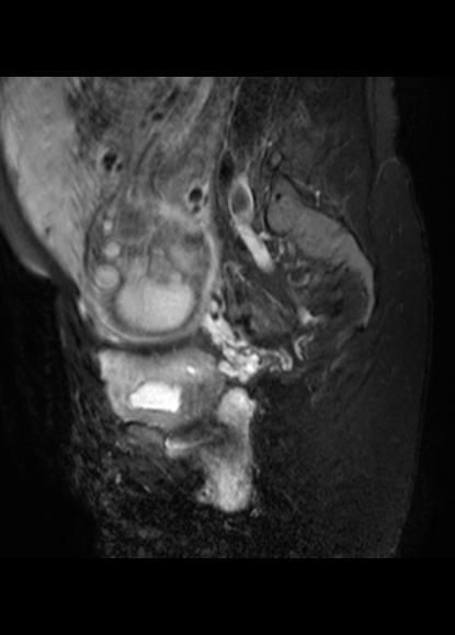 File:Aggressive angiomyxoma of the pelvis and perineum (Radiopaedia 59162-66479 Sagittal T2 fat sat 7).jpg