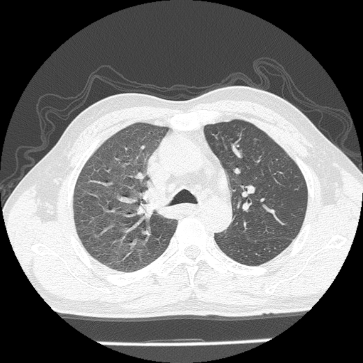 Airway foreign body in adult (Radiopaedia 85907-101779 Axial lung window 50).jpg