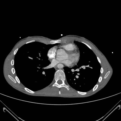 File:Alagille syndrome with pulmonary hypertension (Radiopaedia 49384-54980 A 8).jpg