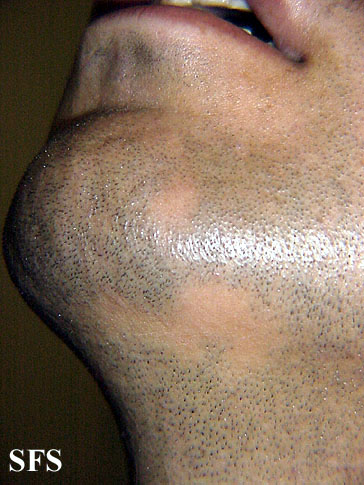 Alopecia Areata (Dermatology Atlas 10).jpg
