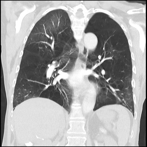 File:Alpha-1-antitrypsin deficiency (Radiopaedia 64893-73840 Coronal lung window 22).jpg