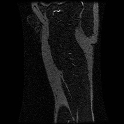 Alveolar soft part sarcoma (Radiopaedia 64501-73678 D 33).jpg