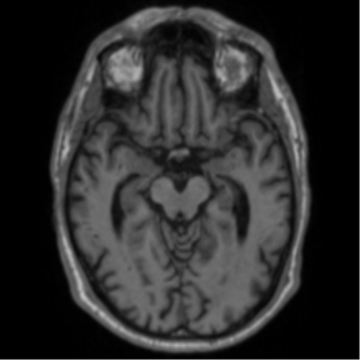 Alzheimer's disease- with Gerstmann syndrome and dressing apraxia (Radiopaedia 54882-61150 Axial T1 30).png