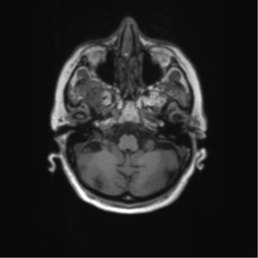 File:Alzheimer's disease (Radiopaedia 42658-45802 Axial T1 123).png