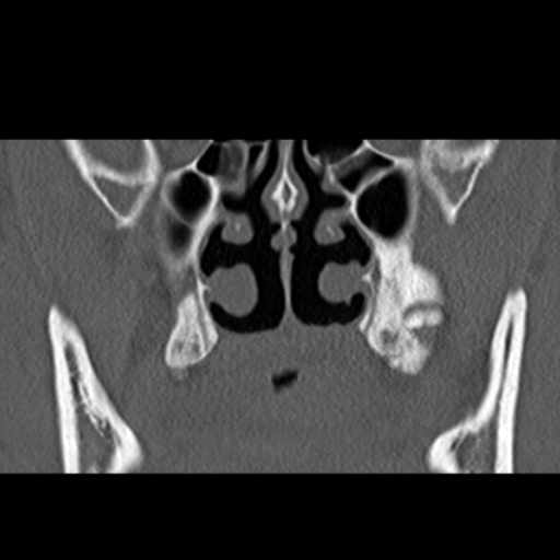 File:Ameloblastic fibro-odontoma (Radiopaedia 18843-18780 B 20).jpg