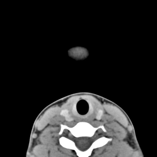 File:Ameloblastoma (Radiopaedia 26645-26793 Axial C+ delayed 2).jpg