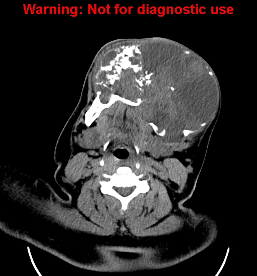 File:Ameloblastoma (Radiopaedia 33126-34164 A 16).jpg