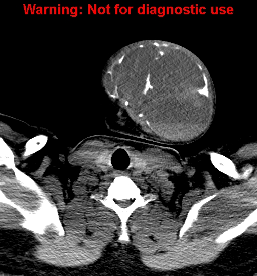 File:Ameloblastoma (Radiopaedia 33126-34164 A 32).jpg