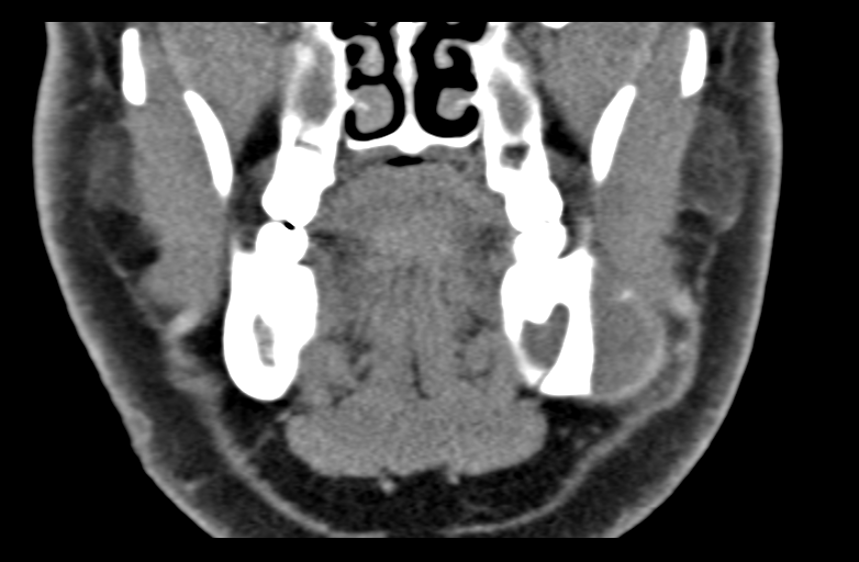 Ameloblastoma (Radiopaedia 33677-34806 Coronal non-contrast 27).png