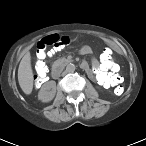 File:Ampullary adenocarcinoma (Radiopaedia 34013-35237 Axial non-contrast 26).png
