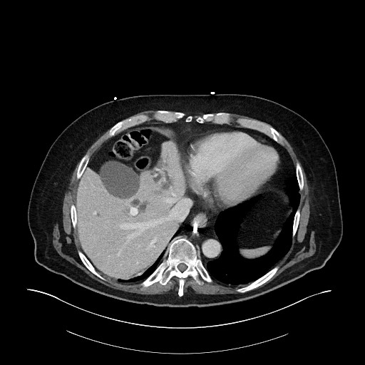 Ampullary adenocarcinoma (Radiopaedia 59373-66734 C 30).jpg