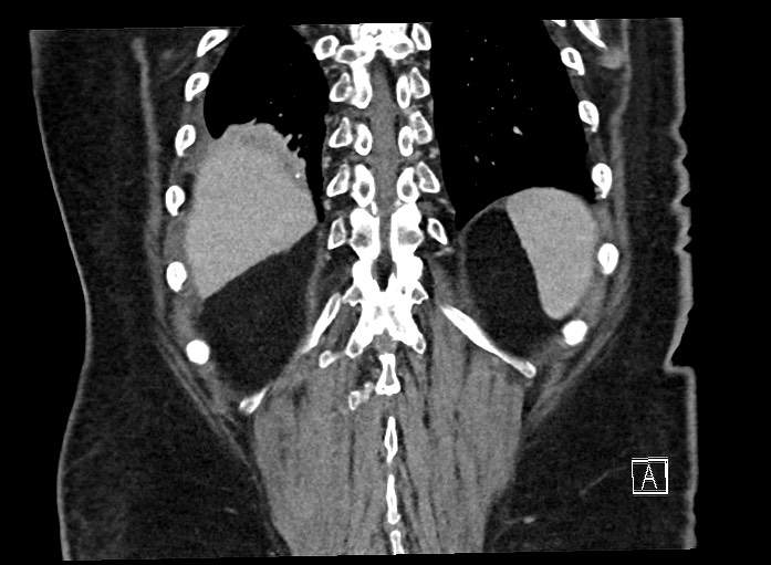File:Ampullary adenocarcinoma (Radiopaedia 59373-66737 B 62).jpg