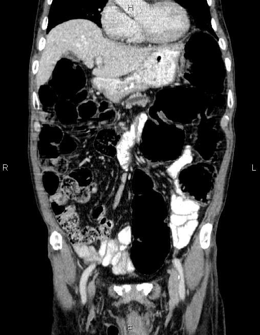 Ampullary adenocarcinoma (Radiopaedia 86093-102032 C 22).jpg