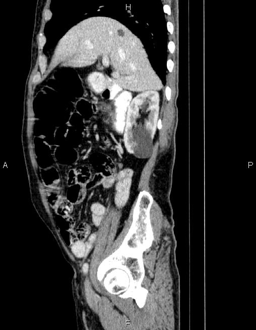Ampullary adenocarcinoma (Radiopaedia 86093-102032 D 27).jpg