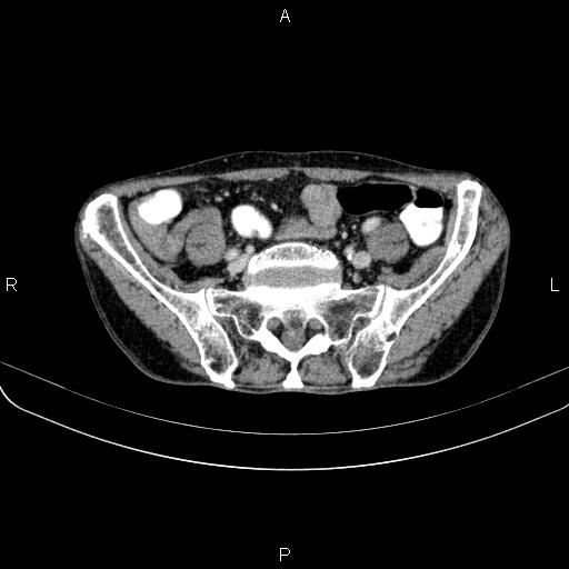 Ampullary adenocarcinoma (Radiopaedia 86093-102033 B 91).jpg