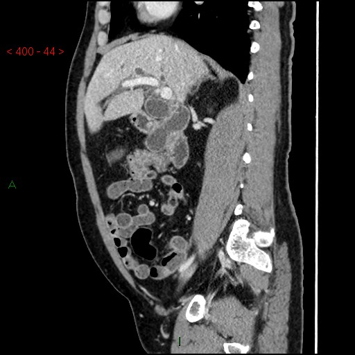 Ampullary carcinoma (Radiopaedia 56396-63056 D 43).jpg